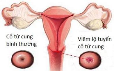 Tìm hiểu về bệnh viêm lộ tuyến cổ tử cung