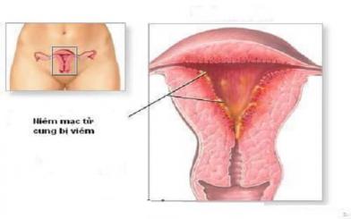  Viêm nội mạc cổ tử cung là gì, nguyên nhân, triệu chứng và cách điều trị