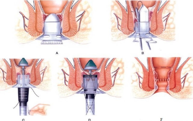 Phương pháp cắt trĩ kinh điển – Longo