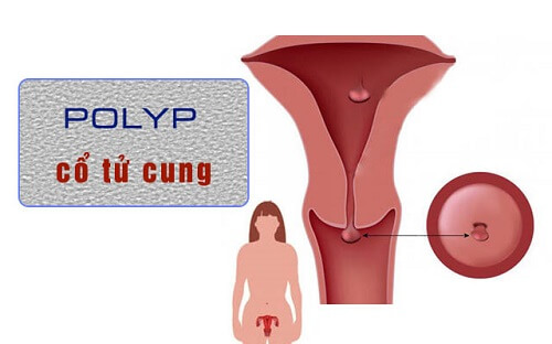Bệnh tử cung - Polyp tử cung
