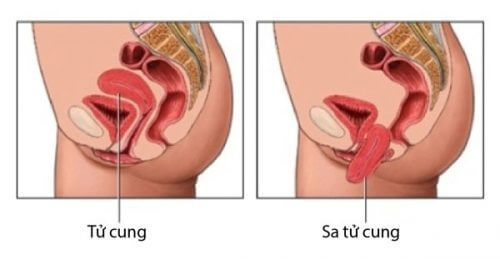 Viêm phụ khoa có đau bụng không – Cảnh báo sa tử cung