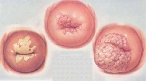 Sùi mào gà ở phụ nữ không được phát hiện sớm và điều trị kịp thời dễ gây ung thư cổ tử cung nguy hiểm