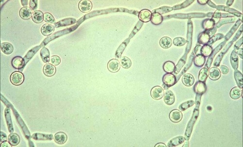 Viêm quy đầu do nhiễm khuẩn Candida albicans