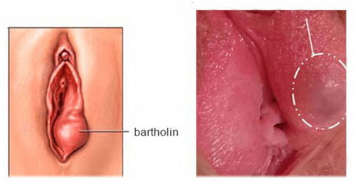 Hình ảnh bệnh viêm tuyến bartholin