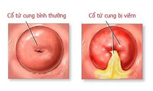 Có thể bạn chưa biết ]Hình ảnh cổ tử cung bị viêm