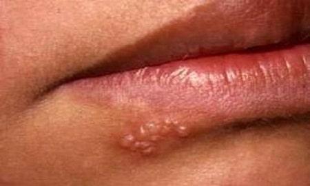Mụn rộp sinh dục ở miệng : Nguyên nhân, triệu chứng và cách điều trị