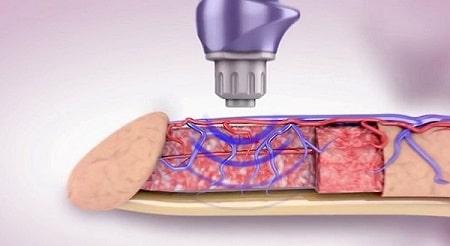 Điều trị xuất tinh sớm bằng sóng xung kích có tốt không và chi phí bao nhiêu ?