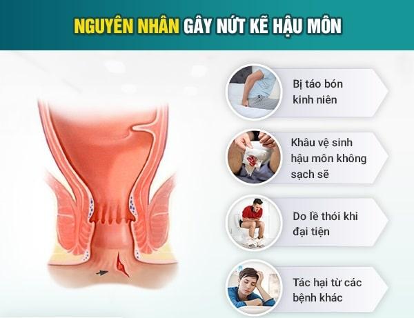 Vì sao bị nứt kẽ hậu môn? Nguyên nhân thường gặp và cách phòng tránh
