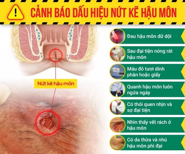 Nứt kẽ hậu môn có gây ung thư không? Giải đáp từ chuyên gia tiêu hóa