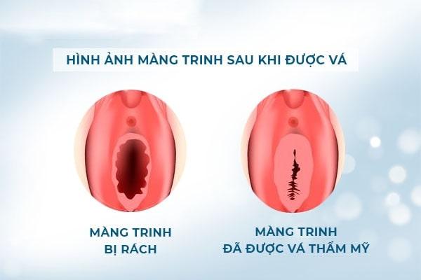 Vá màng trinh có đau không ? Sự thật cần biết trước khi quyết định