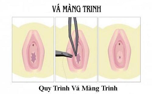 Phẫu thuật vá màng trinh là gì? Quy trình, chi phí và những điều cần biết