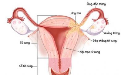Tổng hợp các cách điều trị viêm nội mạc cổ tử cung