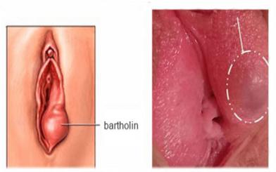  Viêm tuyến bartholin [Tổng hợp kiến thức cho nữ giới]