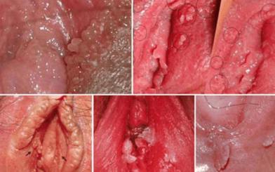 Bệnh sùi mào gà âm đạo ở nữ và cách trị hiệu quả