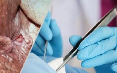 Phẫu thuật cắt da thừa hậu môn và kiến thức liên quan
