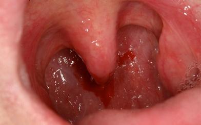 Sùi mào gà ở họng : Nguyên nhân, triệu chứng và cách chữa