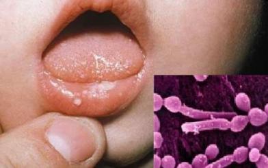 Nấm candida miệng : Nguyên nhân, triệu chứng và cách điều trị hiệu quả