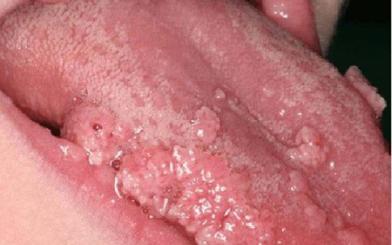 Sùi mào gà ở lưỡi : Nguyên nhân, triệu chứng và cách điều trị hiệu quả