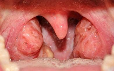 Sùi mào gà ở họng là gì ? Nguyên nhân, triệu chứng và cách điều trị hiệu quả