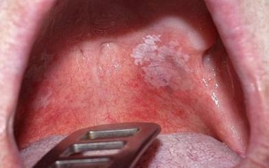 [ Review ] 10+ dấu hiệu bệnh lậu ở miệng dễ nhận biết nhất hiện nay