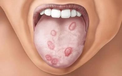 Giang mai ở lưỡi : Nguyên nhân, triệu chứng và cách điều trị hiệu quả