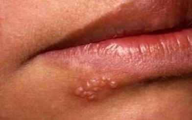 Mụn rộp sinh dục ở miệng : Nguyên nhân, triệu chứng và cách điều trị
