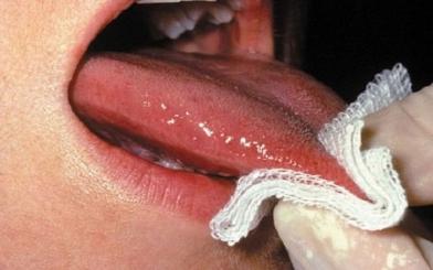 Mụn rộp sinh dục ở lưỡi : Nguyên nhân, triệu chứng và cách điều trị hiệu quả