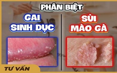 Gai sinh dục : Nguyên nhân, triệu chứng và 3 cách chữa hiệu quả 2024