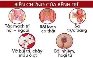 Bệnh trĩ nội có lây không và chữa như nào hiệu quả ?