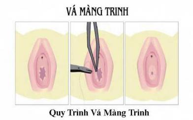 Vá màng trinh là gì? Chi phí, quy trình và những điều phụ nữ cần biết