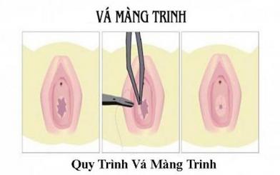 Phẫu thuật vá màng trinh là gì? Quy trình, chi phí và những điều cần biết