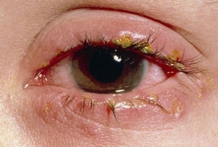Các triệu chứng điển hình của bệnh giang mai ở mắt