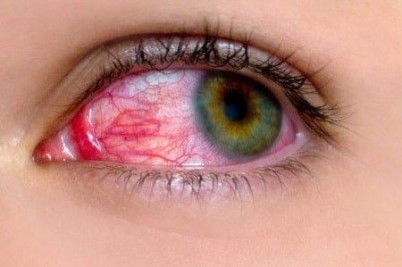 Giang mai ở mắt là bệnh gì ?