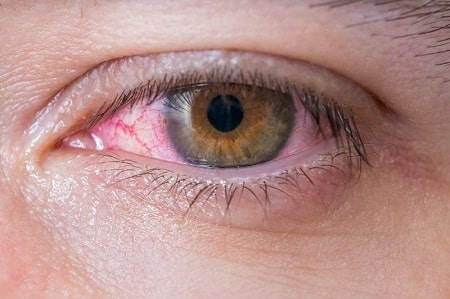 Những biểu hiện lậu mắt có nguy hiểm không? 