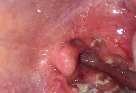 Những con đường nào dẫn đến bệnh lậu ở miệng?