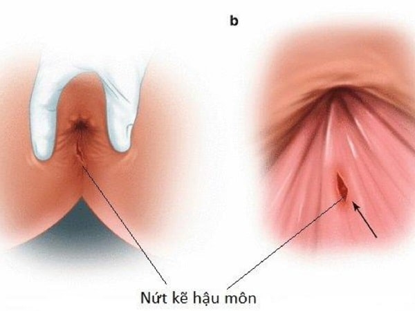 Giải đáp nứt kẽ hậu môn là gì ?