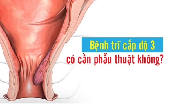 Bệnh trĩ nội độ 3 có cần phẫu thuật không?