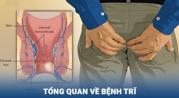 Tổng quan về bệnh trĩ