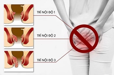 Làm sao để phát hiện bản thân bị trĩ nội độ 1 ?