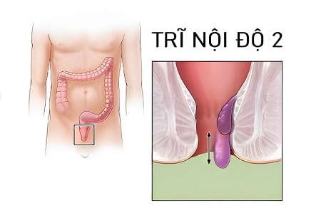 Bạn hiểu thế nào là bệnh trĩ nội độ 2 ?