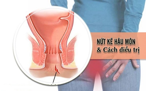 Bệnh nứt kẽ hậu môn có thực sự gây nguy hiểm không?