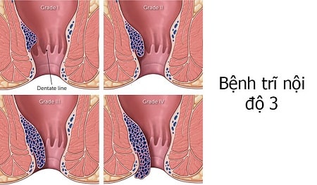 Đôi nét thông tin tổng quan giúp bạn nhận diện bệnh trĩ nội độ 3