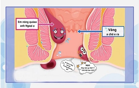 Nhận biết những yếu tố khiến bệnh trĩ nội hình thành