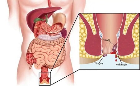 Một số thông tin về bệnh trĩ bạn không nên bỏ qua