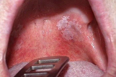 Những ảnh hưởng từ bệnh lậu ở miệng