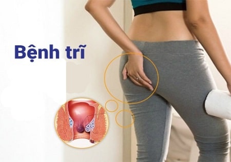 Các tiêu chí để lựa chọn một địa chỉ chữa bệnh trĩ tốt tại Hà Nội