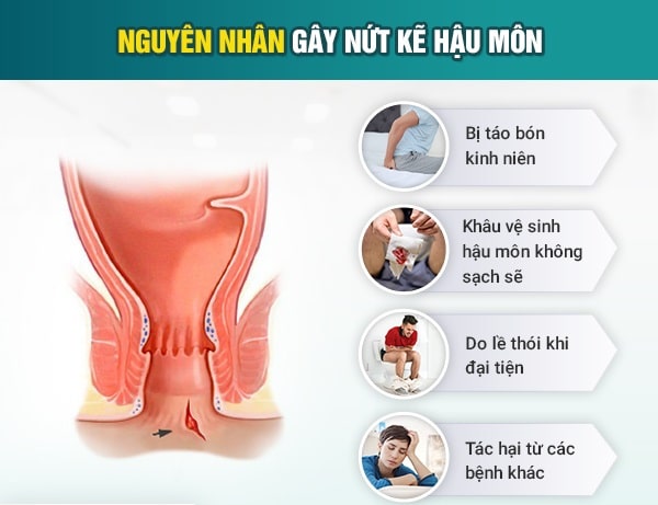 Nắm bắt nguyên nhân và triệu chứng để điều trị nứt kẽ hậu môn hiệu quả