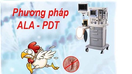 ALA - PDT chữa sùi mào gà và những ưu điểm mang lại