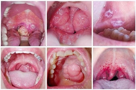 Nguyên nhân dẫn đến bệnh giang mai miệng 