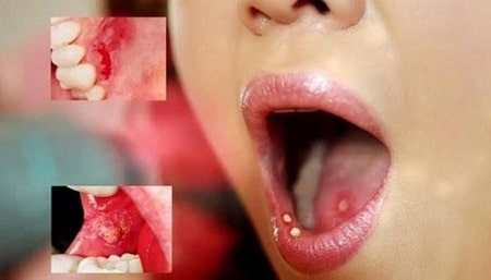 Bệnh giang mai ở miệng là gì ?